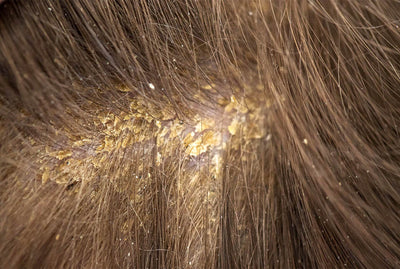 HOW TO SPOT THE SYMPTOMS OF SEBORRHEIC DERMATITIS