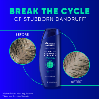 Break the Cycle of Stubborn Dandruff