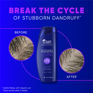 Break the Cycle of Stubborn Dandruff