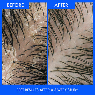 Avocado Oil 2 in 1 Anti-Dandruff Shampoo and Conditioner, 380ml